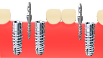 Interimsimplantate Indikation
