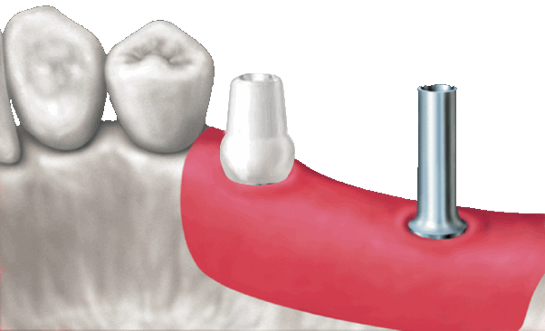 Festsitzender und bedingt abnehmbarer Zahnersatz